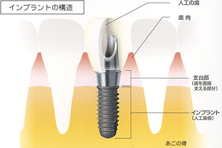 インプラントの構造